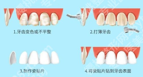 梅州人民医院牙齿贴片怎么样？一键进入了用户反馈