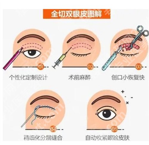 蚌埠医学院第一附属医院做双眼皮怎么样？看项目、价格介绍