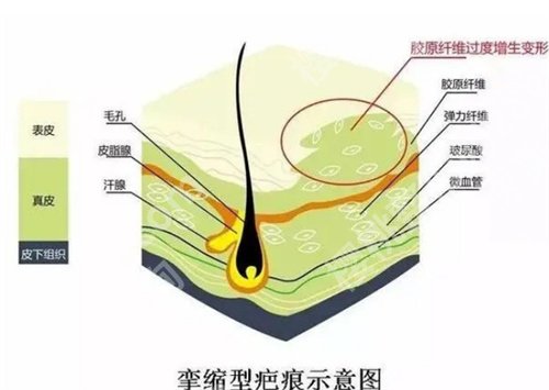 上海六院激光祛疤怎么样?一览详细价格表