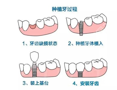 上海第十人民医院种牙多少钱？看项目优势介绍