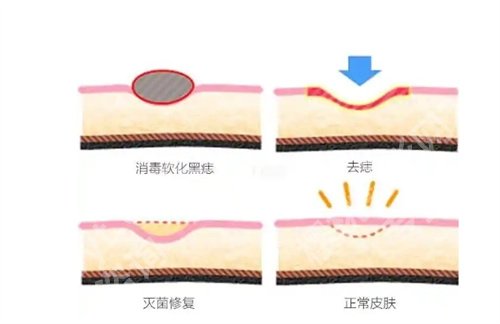 广州珠江医院激光点痣多少钱? 看医院项目收费介绍