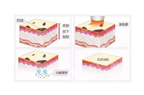 广州珠江医院激光点痣多少钱? 看医院项目收费介绍