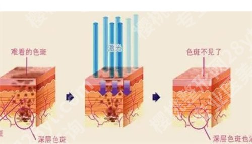 中山大学附属第三医院祛斑多少钱？医院详情，口碑点评