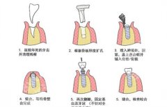 北京大学第三医院种牙科收费标准？医院信息介绍，点击一览