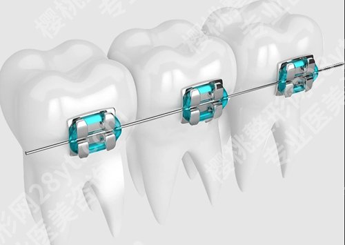 花都区人民医院牙齿矫正多少钱？牙齿矫正价格为7000元起