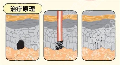 济宁附属医院点阵激光技术怎么样？看医院技术优势介绍