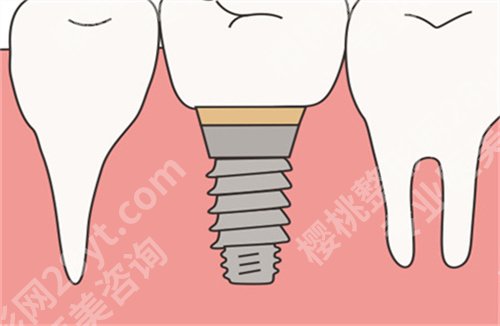 上海九医院种植牙多少钱？2024年价格表更新了