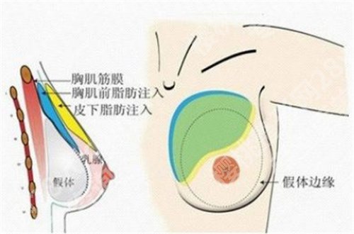 上海华美谢卫国做胸好吗？一文查看医院医生信息 