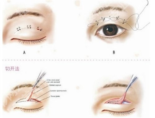 朱武根割双眼皮怎么样？医院+医生简介，好评在线看
