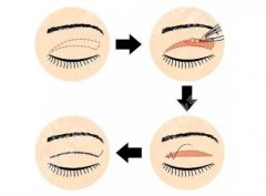 伯思立徐晓斐双眼皮修复好吗？医院详情公布，医生实力在线看