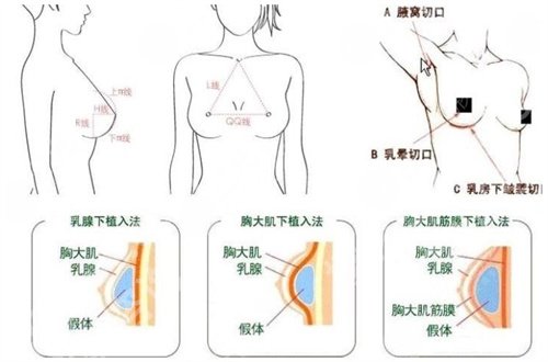 深圳米兰柏羽医学美容医院做胸怎么样？看真是的顾客点评