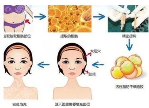 杭州第一人民医院脂肪填充价格是多少?收费明细在线预览