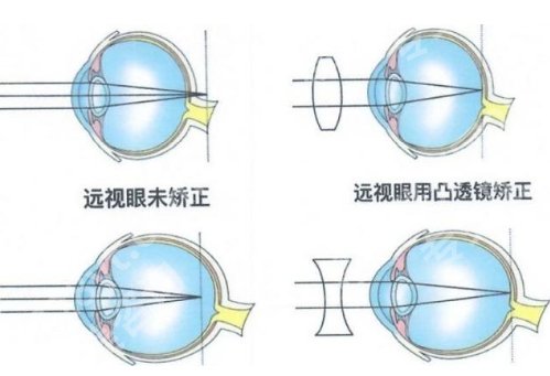 北大深圳医院近视激光费用贵吗？科室实力曝光