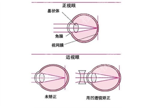 中山大学中山眼科中心近视激光手术怎么样？医院详情介绍