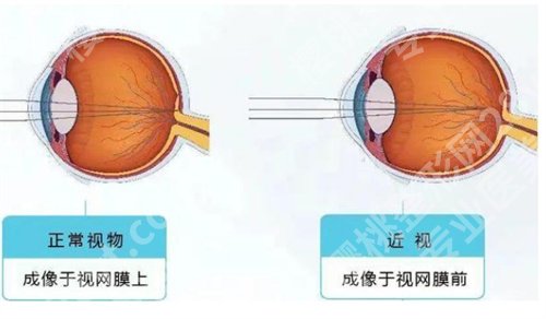 中山大学中山眼科中心近视激光手术怎么样？医院详情介绍