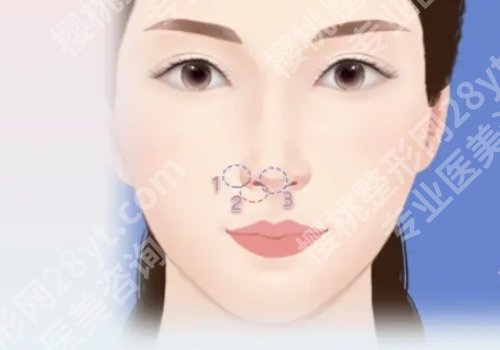 上海华美整形鼻部整形多少钱？医院技术优势、地址一览