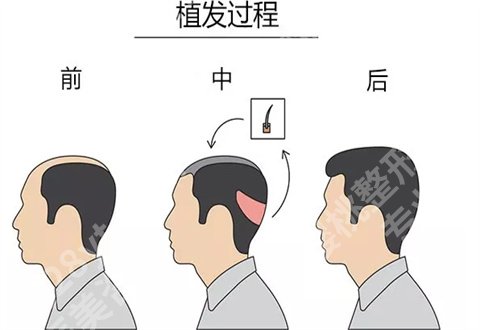 成都大麦微针植发是正规医院吗？热门项目介绍了优势