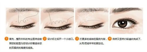 朱武根双眼皮案例在线预览!看口碑案例介绍