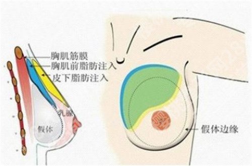 深圳美加美隆胸价格怎么样？医院详情介绍，口碑点评
