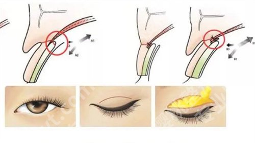 深圳富华整形医院割双眼皮技术好吗？看医院详细介绍