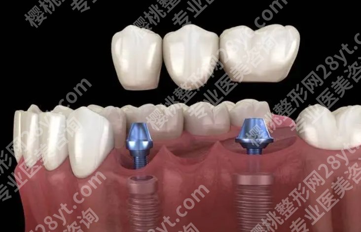 空军军医大学口腔医院种植牙哪个医生好？2025牙齿种植费用参考