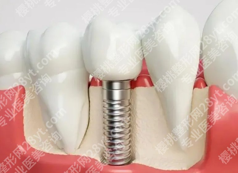 四川华西口腔医院种植牙多少钱一颗？牙齿种植过程一览