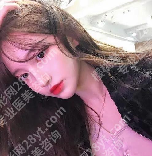 上海严红飞医生做双眼皮怎么样啊？赶紧来看看双眼皮案例过程反馈