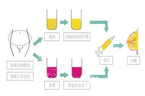 上海华美自体脂肪丰胸做的怎么样？收费明细+点评信息