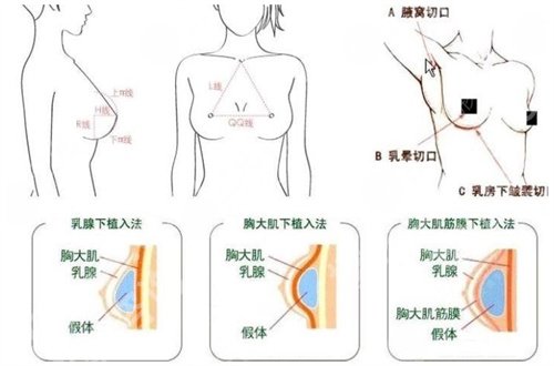 广州军美抽脂怎么样？科普知识已经回答清楚了