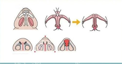 深圳福华做鼻子怎么样？看特色项目介绍