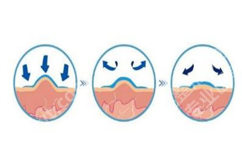 激光祛疤真实果图片？激光祛疤后需要冰敷吗？