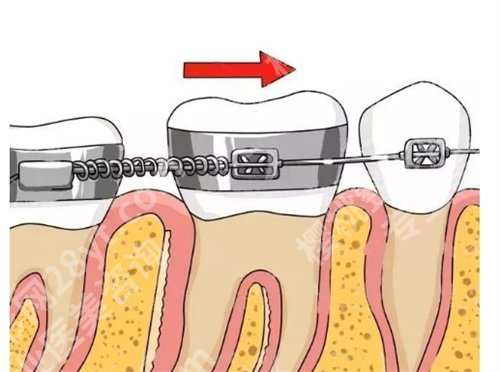 北京安贞医院牙齿矫正怎么样？价格明细公布