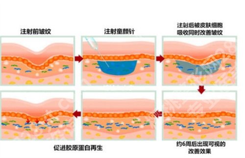 苏大附一院光子嫩肤？相关案例分析