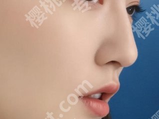 罗延平做的鼻子图片曝光|做鼻部整形面诊小技巧get！