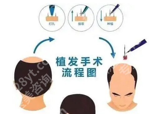 广州南方医院植发贵吗？2025收费明细公布