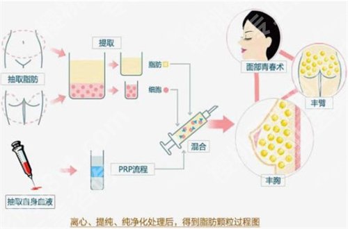 上海第十人民医院整形科价格表，热门脂肪填充的科普知识整理