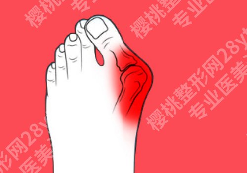 马桂文医生现在哪家医院?(大脚骨微创)做的怎么样？