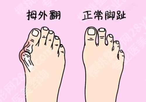 马桂文医生现在哪家医院?(大脚骨微创)做的怎么样？