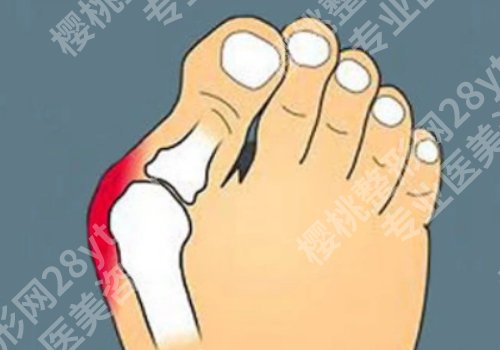 马桂文医生现在哪家医院?(大脚骨微创)做的怎么样？