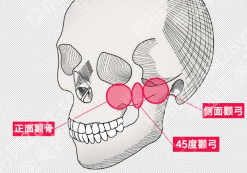 黄敬夏磨骨会下垂吗？医生口碑点评、价格参考、真人案例