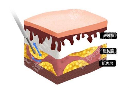 王衡健吸脂咋样?医生技术、口碑点评来袭