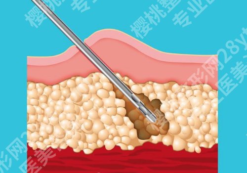 陈孝闯吸脂案例已更新!医生介绍、价格表、术后小tips