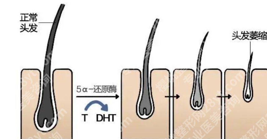 郑州医德佳医院植发怎样？真人做植发项目案例鉴赏！