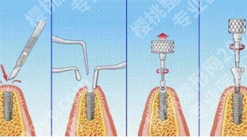 普宁人民医院种牙怎么样？医院详情介绍