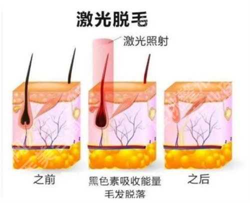 龙华人民医院整形科冰点脱毛收费如何?口碑点评来袭