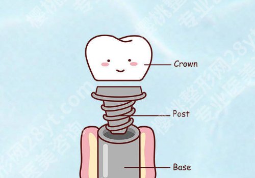 义乌种植牙价格表更新公开!义乌第二人民医院、义乌市中心医院、义乌欧莱美医院性价比超高