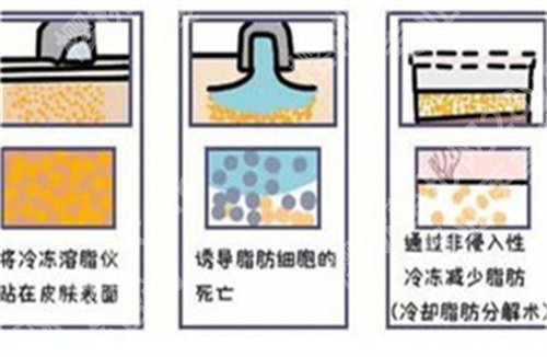 上海刘志欣医生简介？医生吸脂案例分享