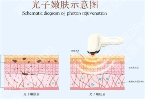 北大深圳医院光子嫩肤怎么样？主打项目，一文探索