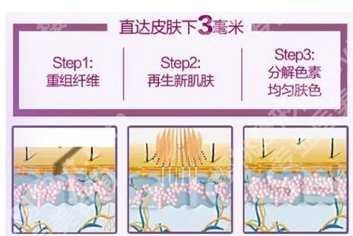 深圳人民医院激光祛斑多少钱一次?基本信息一览