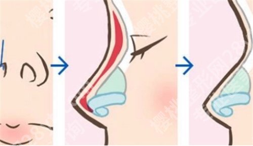 上海范锴医生做鼻子怎么样？医生详细介绍